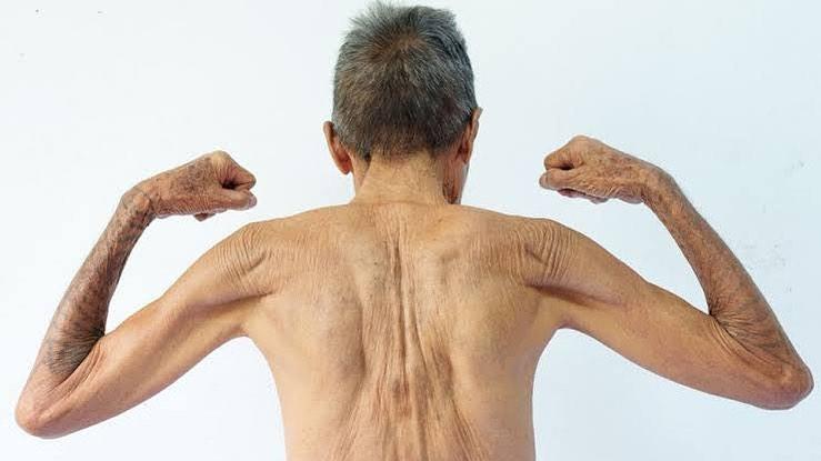 O Que A Sarcopenia E Quais Os Tratamentos Cinform Online